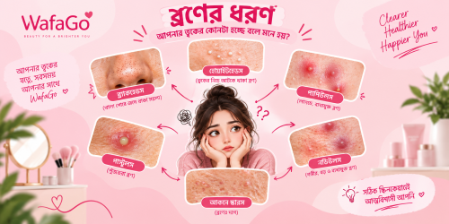 ব্রণের ধরন চিনুন: আপনার স্কিনে কোন ধরনের অ্যাকনে হচ্ছে?